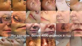 Чем быстро вывести папилломы в Дикси